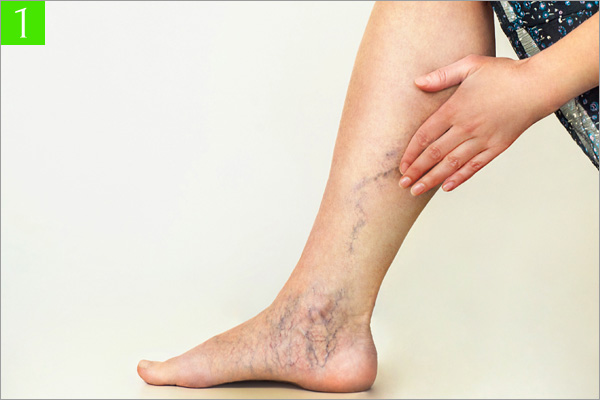 足のむくみ専門サロン ココアは下肢静脈瘤やリンパ浮腫にも対応