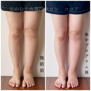 原発性のリンパ浮腫、むくみが改善してスニーカーが緩くなった！