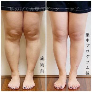 まるで別人！！足のむくみ、短期間でここまで変わる