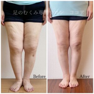 足のむくみとセルライト、プログラムを終了した今も戻らない