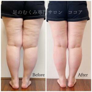 ボコボコのセルライト、原因はむくみ